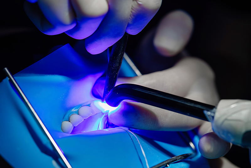 veneer bonding