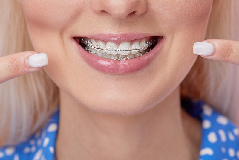 woman showing off damon braces