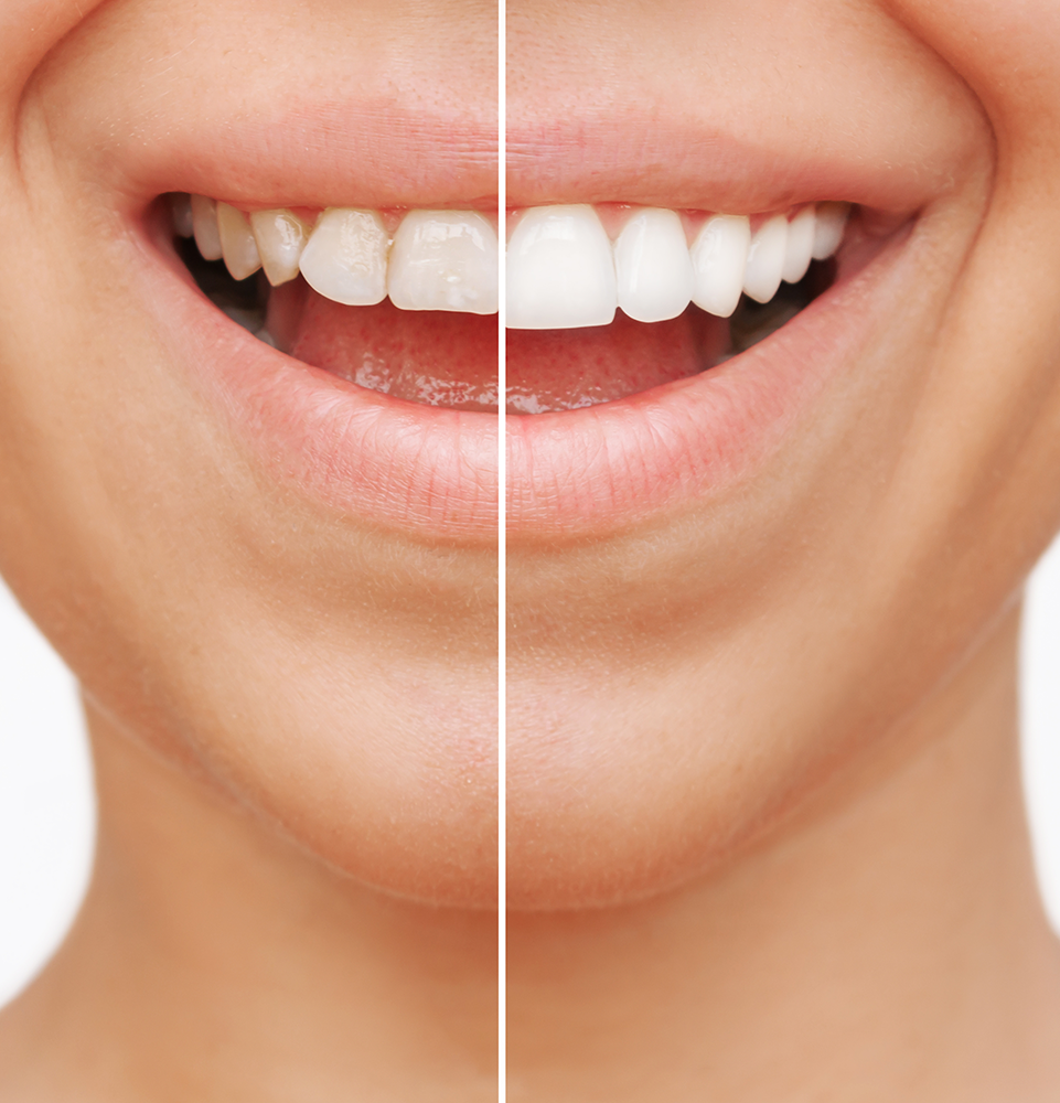 before and after. photo of person with dental veneers
