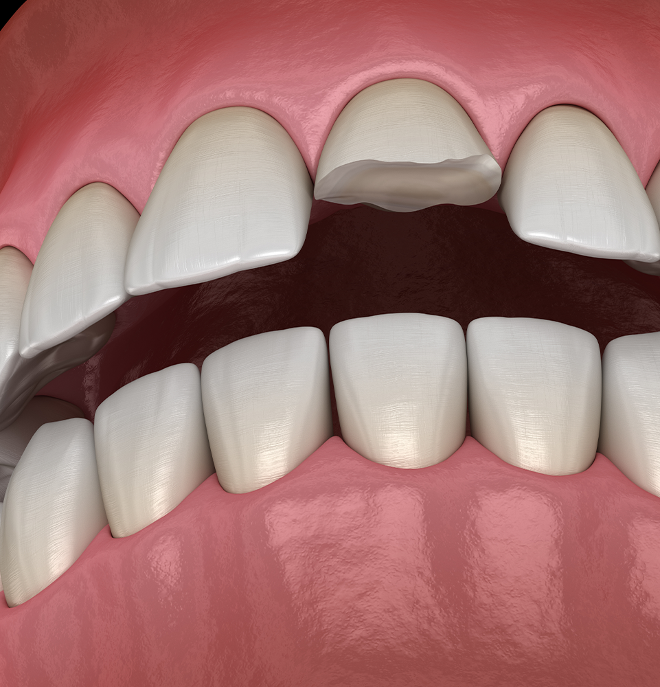 illustration of a cracked tooth