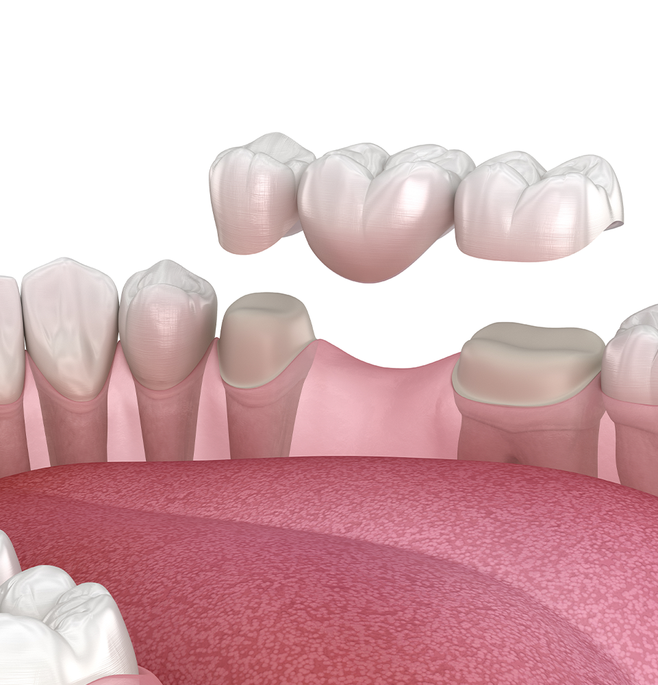 dental bridge going on top of teeth