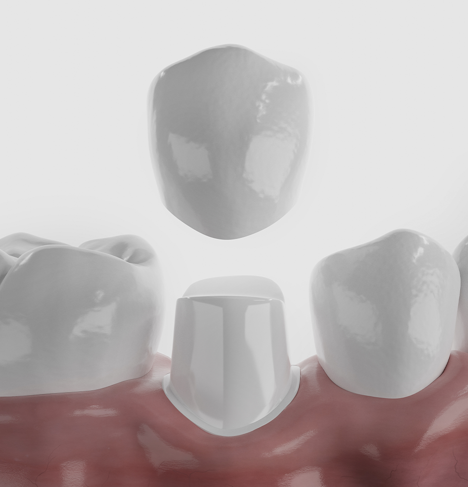 a dental crown going on top of a tooth