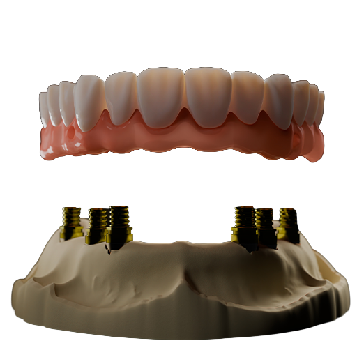 full arch implant
