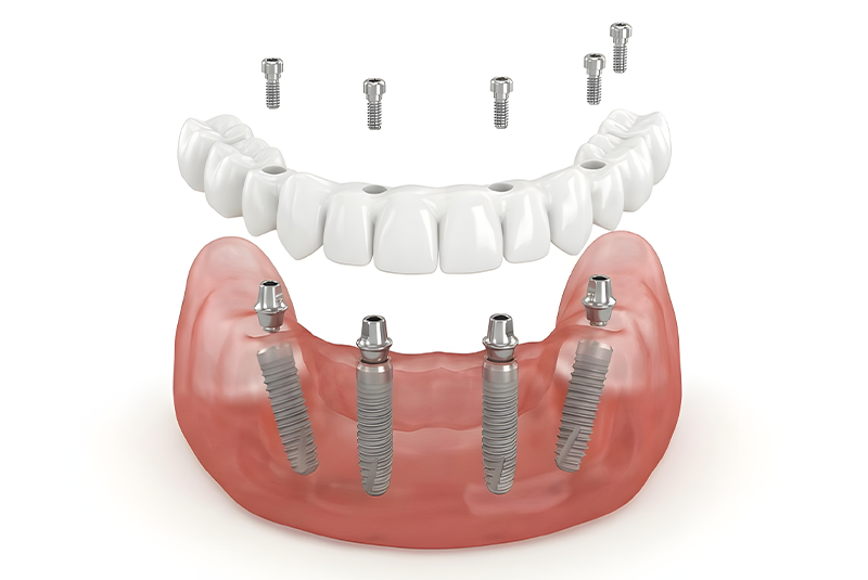 full arch animated dental implant model