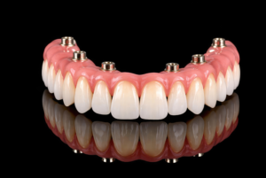 upper set of full arch dental implant model