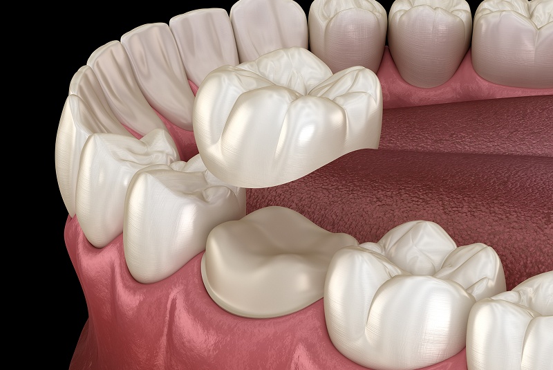Preparated molar tooth for dental crown placement. Medically accurate 3D illustration