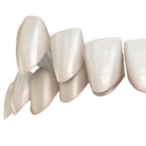 dental veneers