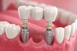 implant-supported bridge